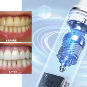 before after teeth whitening with Clearpik